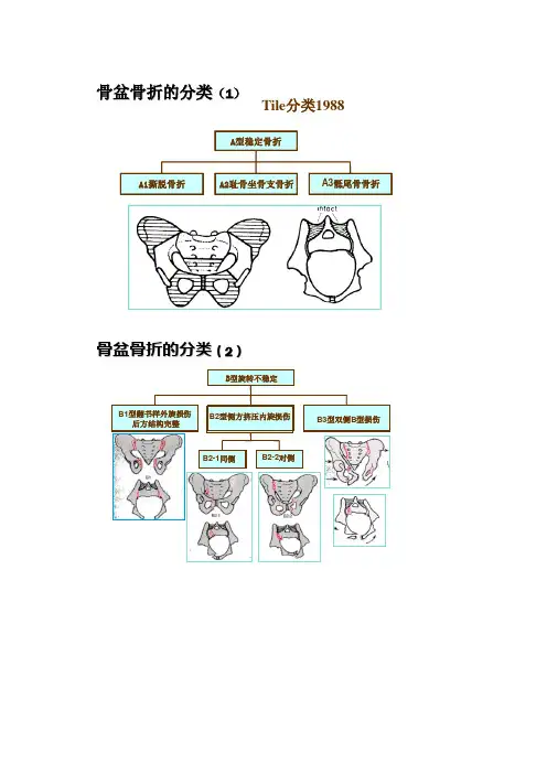骨盆骨折分类及处理