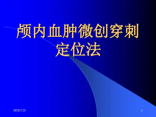 颅内血肿穿刺定位法
