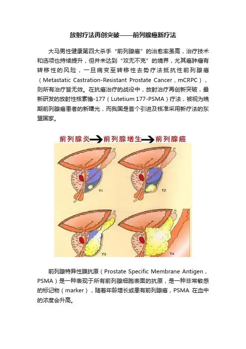 放射疗法再创突破——前列腺癌新疗法