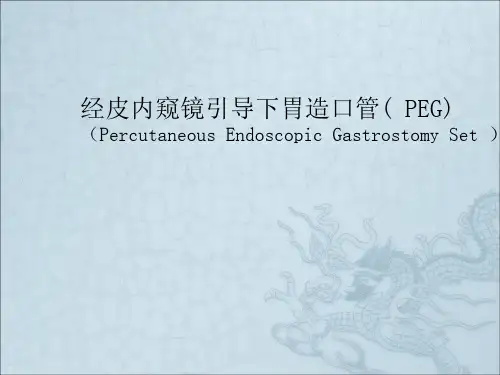 经皮内窥镜引导下胃造口技术