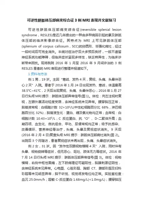 可逆性胼胝体压部病变综合征3例MRI表现并文献复习