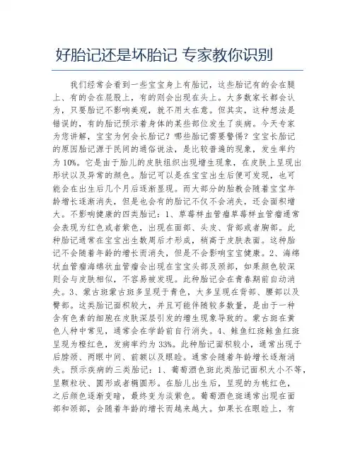 好胎记还是坏胎记 专家教你识别
