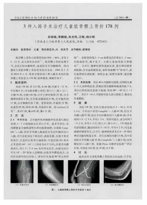 3种入路手术治疗儿童肱骨髁上骨折178例