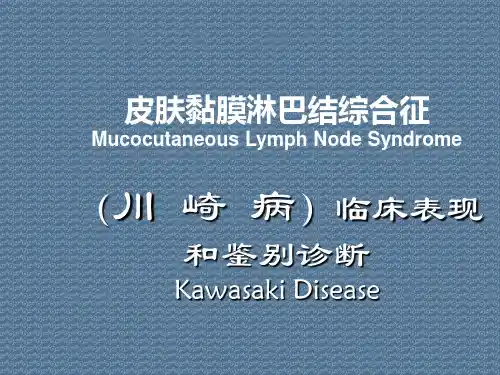 皮肤黏膜淋巴结综合征MucocutaneousLymphNodeSyndrome(川崎病)临床表现和鉴别诊断KawasakiDisease