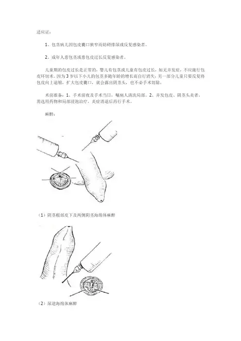 包皮环切术图解