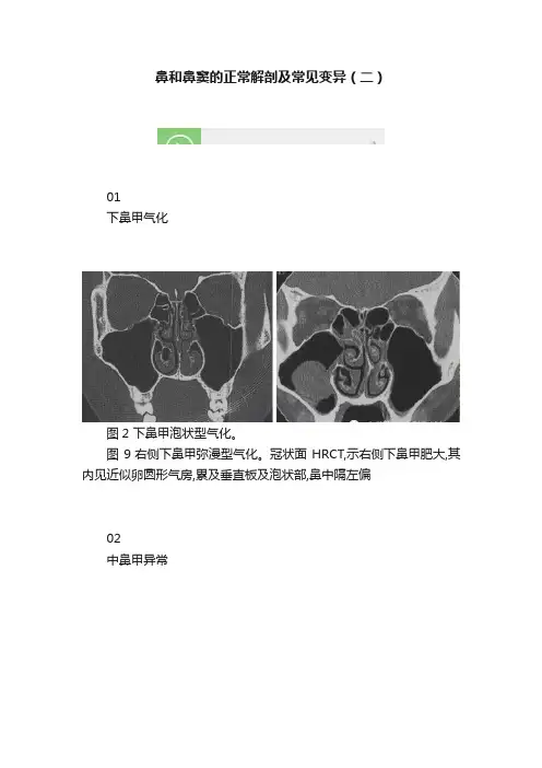 鼻和鼻窦的正常解剖及常见变异（二）