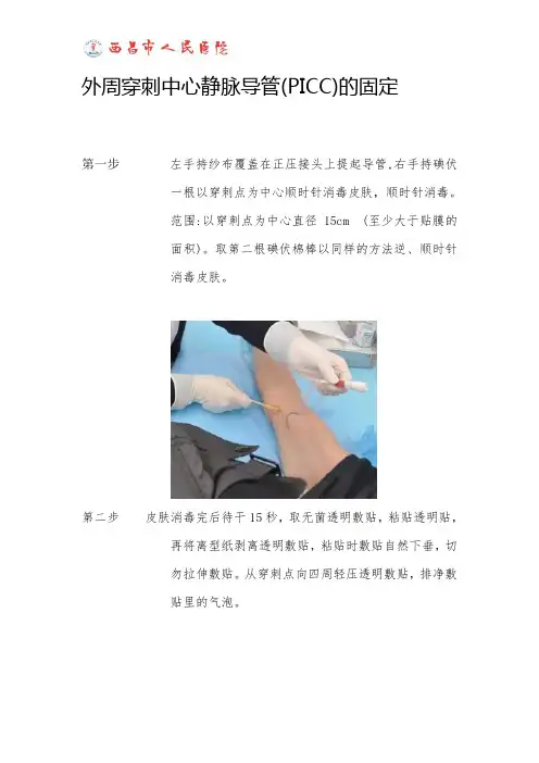 中心静脉导管(PICC)及中长导管的固定