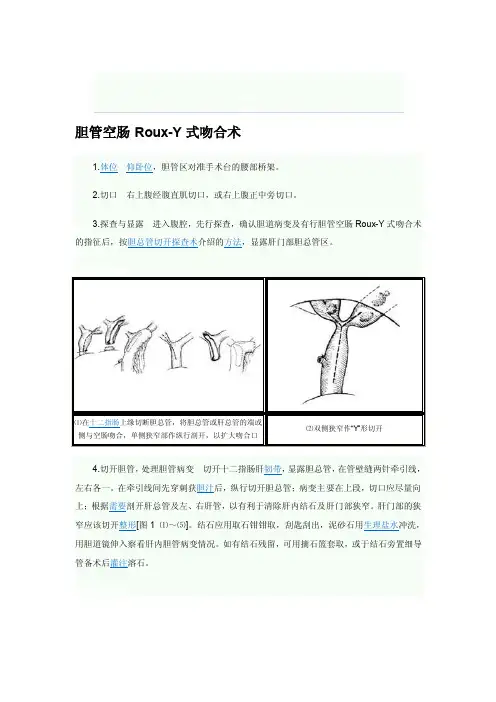 [指南]r-y吻合