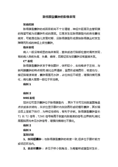 脉络膜裂囊肿的影像表现