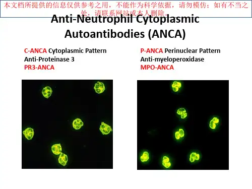 ANCA相关性血管炎肾损害病理表现培训课件