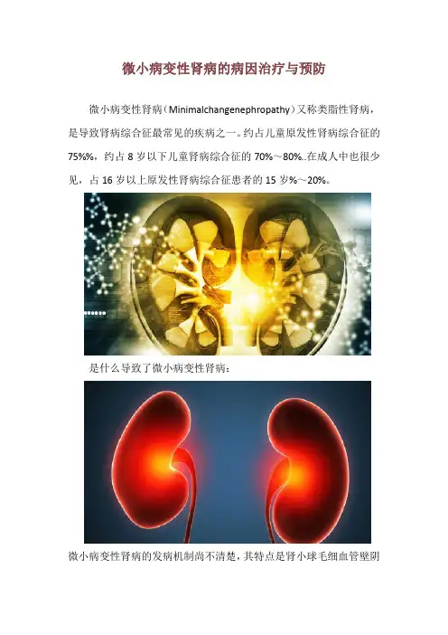 微小病变性肾病的病因治疗与预防