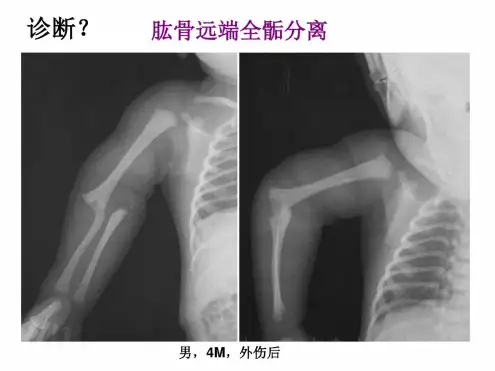 儿童骨骺损伤影像诊断急课件
