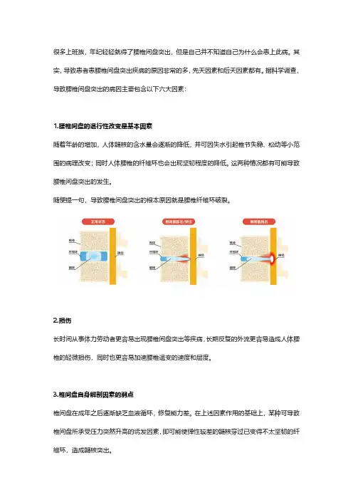 腰椎间盘突出病因大全及椎间盘修复再生疗法介绍