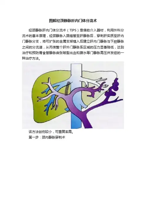 图解经颈静脉肝内门体分流术