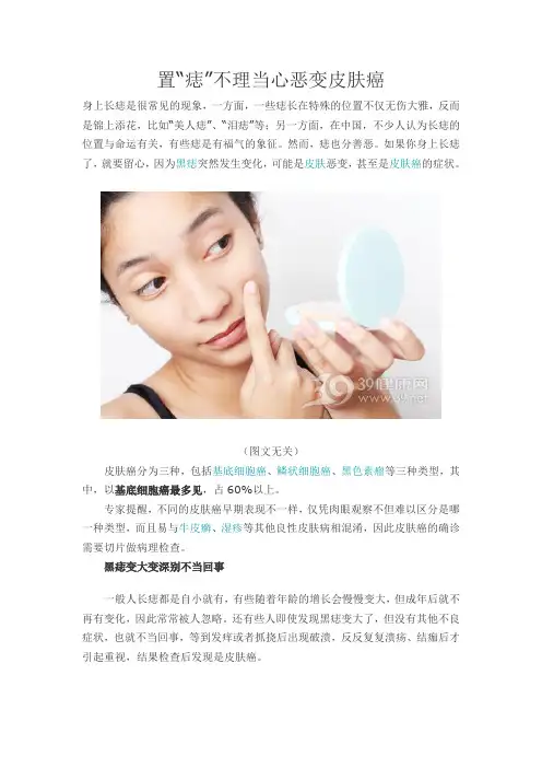 置“痣”不理当心恶变皮肤癌