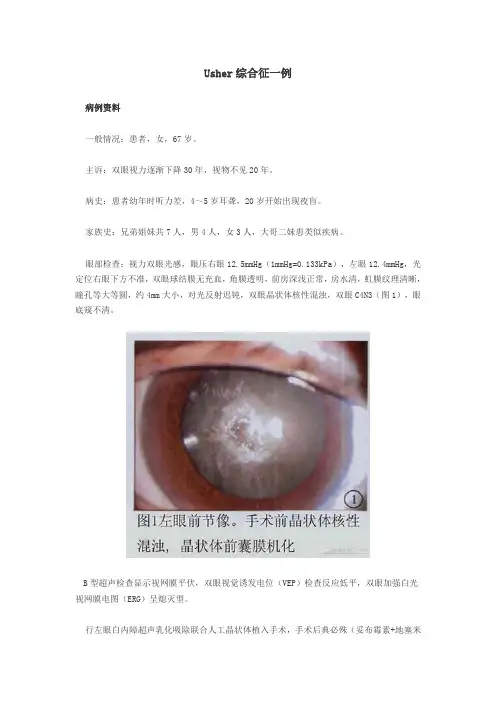 Usher综合征一例