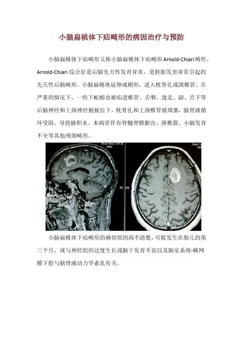 小脑扁桃体下疝畸形的病因治疗与预防