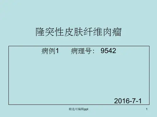 隆突性皮纤维肉瘤