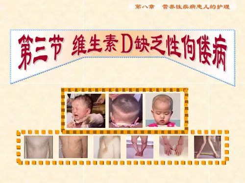 第8章_营养性疾病患儿的护理2