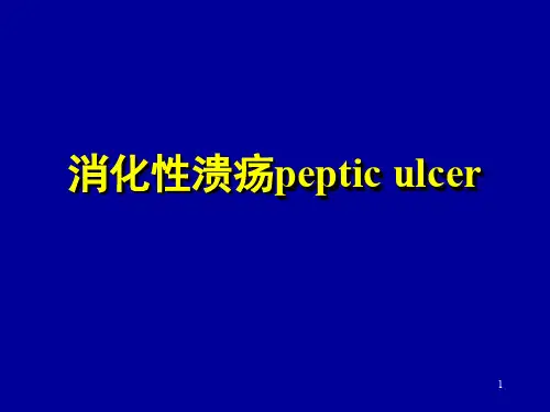 消化性溃疡ppt课件