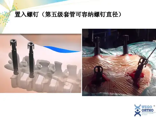 威高UPASS II脊柱微创系统