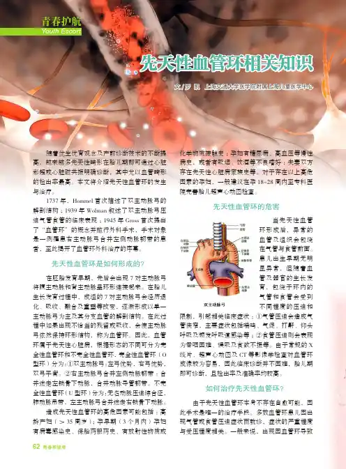 先天性血管环相关知识