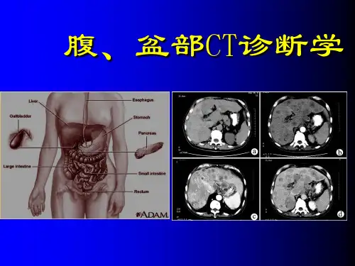腹部,盆腔CT