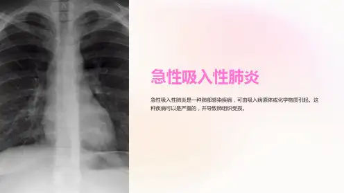 急性吸入性肺炎