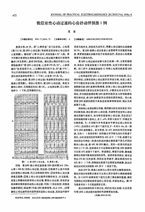 貌似室性心动过速的心房扑动伴预激1例
