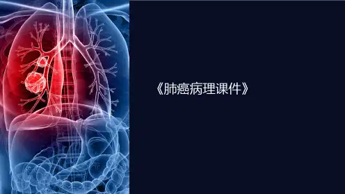 《肺癌病理课件》