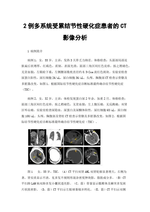 2例多系统受累结节性硬化症患者的CT影像分析