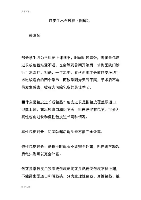包皮手术全过程(现用图解)。