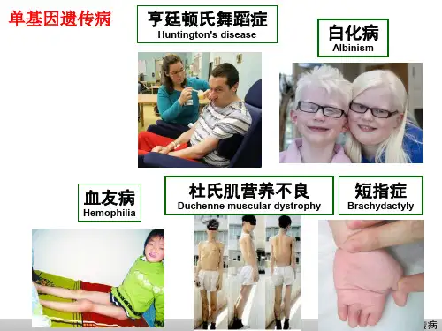 医学遗传学课件PPT第七章 多基因遗传病