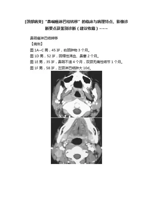 [颈部病变]“鼻咽癌淋巴结转移”的临床与病理特点、影像诊断要点及鉴别诊断（建议收藏）~~~