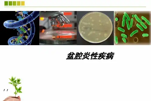 盆腔炎ppt课件