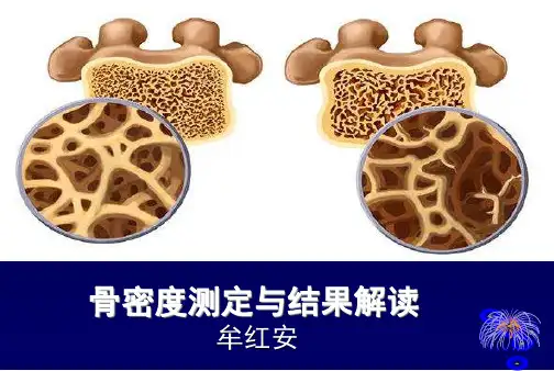 骨密度测定与结果解读