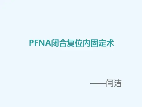 PFNA闭合复位内固定术 PPT