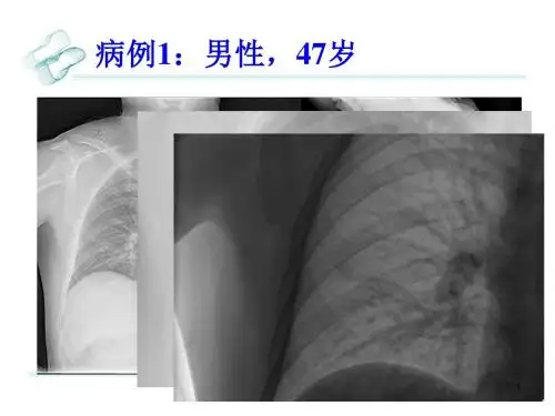 肺硬化性血管瘤影像学诊断ppt课件