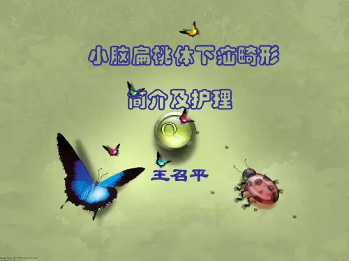 小脑扁桃体下疝(Chiari畸形)