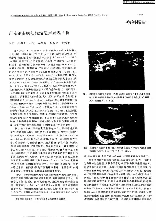 卵巢卵泡膜细胞瘤超声表现2例