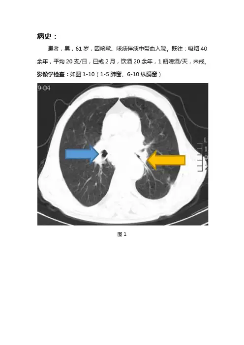 中心型肺癌CT诊断及鉴别诊断