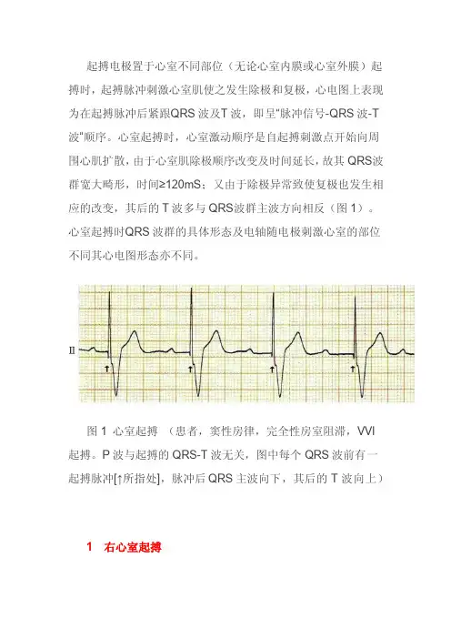 图解心室不同部位起搏心电图
