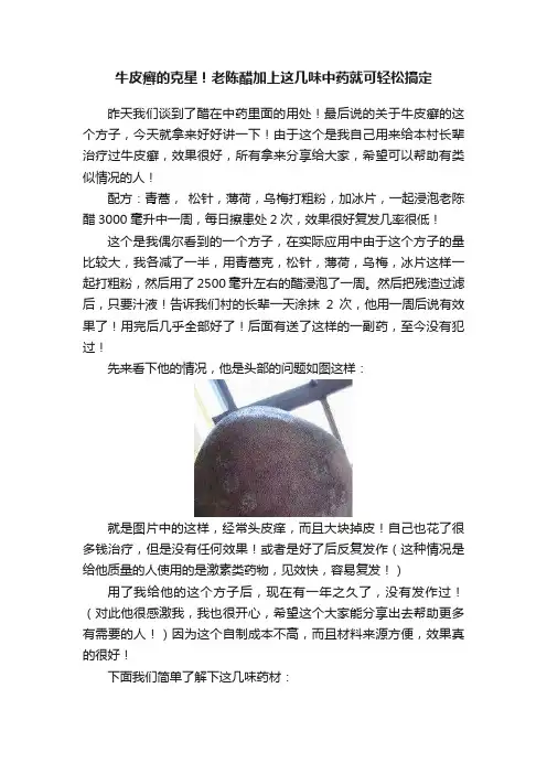 牛皮癣的克星！老陈醋加上这几味中药就可轻松搞定