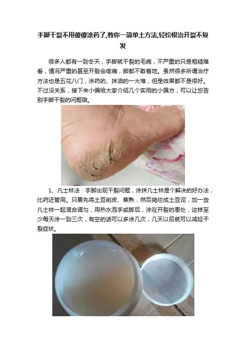 手脚干裂不用傻傻涂药了,教你一简单土方法,轻松根治开裂不复发
