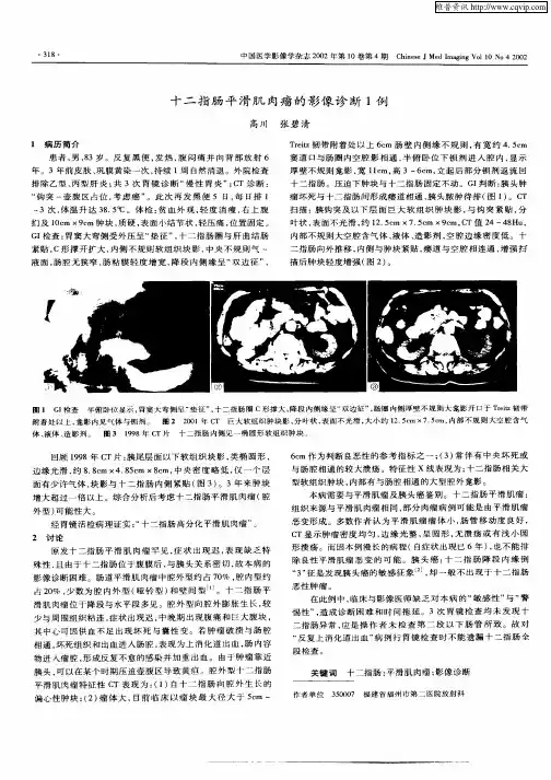 十二指肠平滑肌肉瘤的影像诊断1例