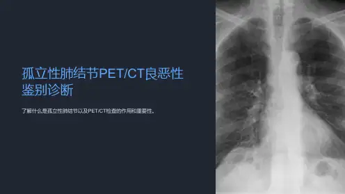 孤立性肺结节petct良恶性鉴别诊断