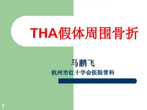 业务学习假体周围骨折PPT课件