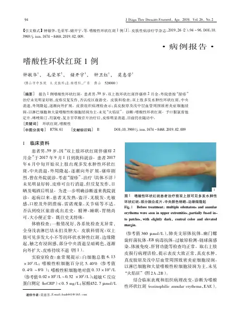 嗜酸性环状红斑1例