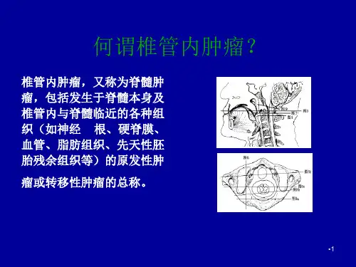椎管内肿瘤及MRI表现