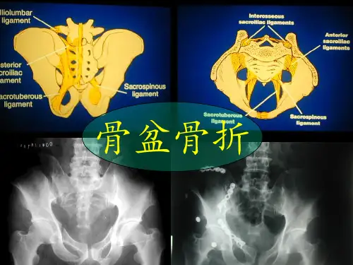 骨盆损伤PPT课件